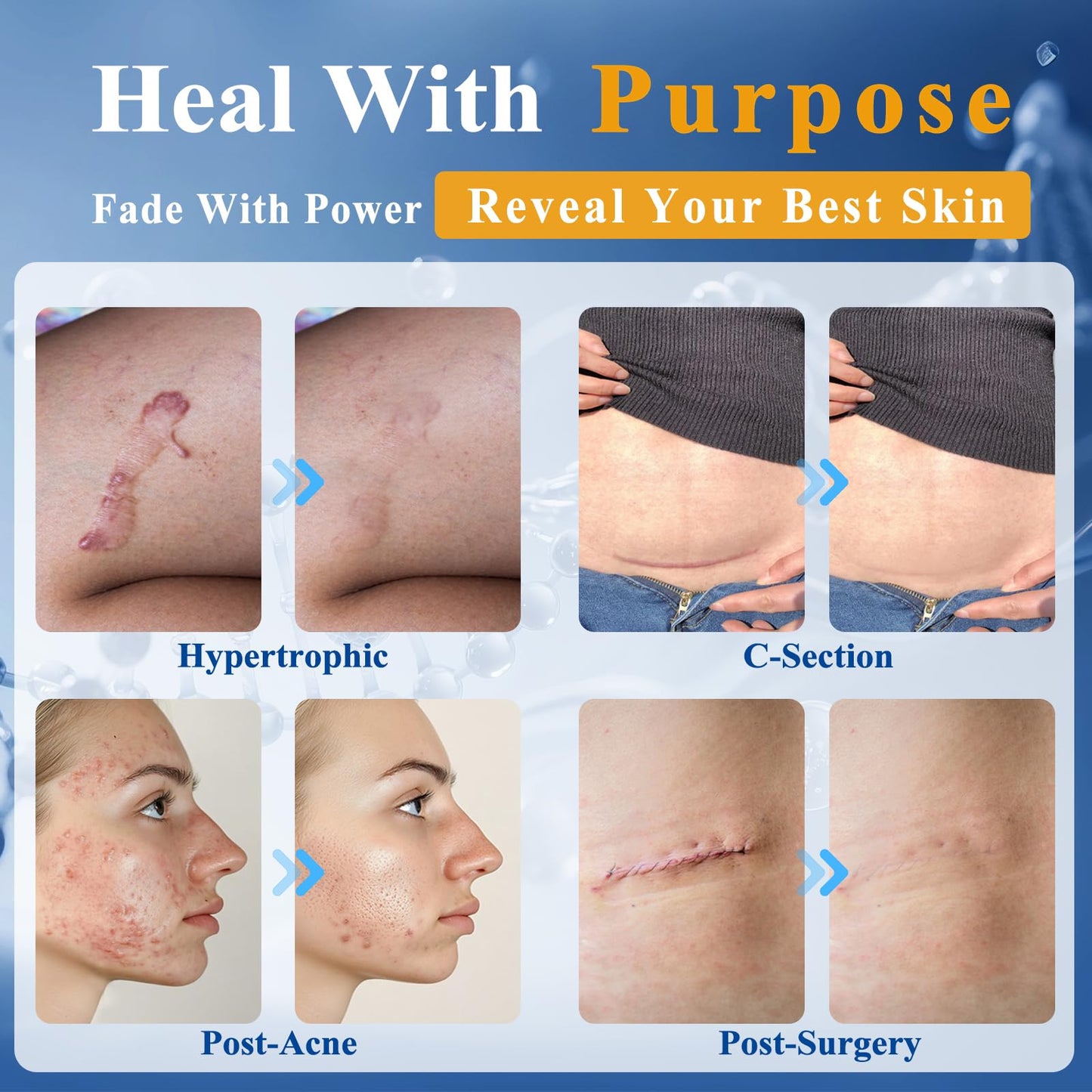 Arme Physician Formulated Patented 52% Silicone Scar Gel Scar Cream, Scar Removal Cream for Surgical Scars,Scar Treatment for Face,Body, Surgical, Burns, Keloid Acne,C Section,Stretch Marks,1.76oz/50g