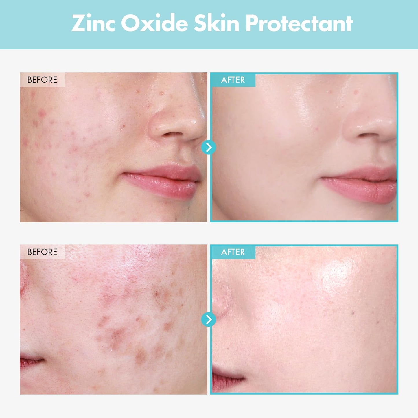 TOSOWOONG Zinc Oxide 10 Cream, 100,000ppm Zinc Oxide, Heal, Soothe Acne, Redness, Rosacea Treatment, Skin Barrier Repair, Moisture, Non-Comedogenic, Korean Skincare, 50g, 1.76 oz.