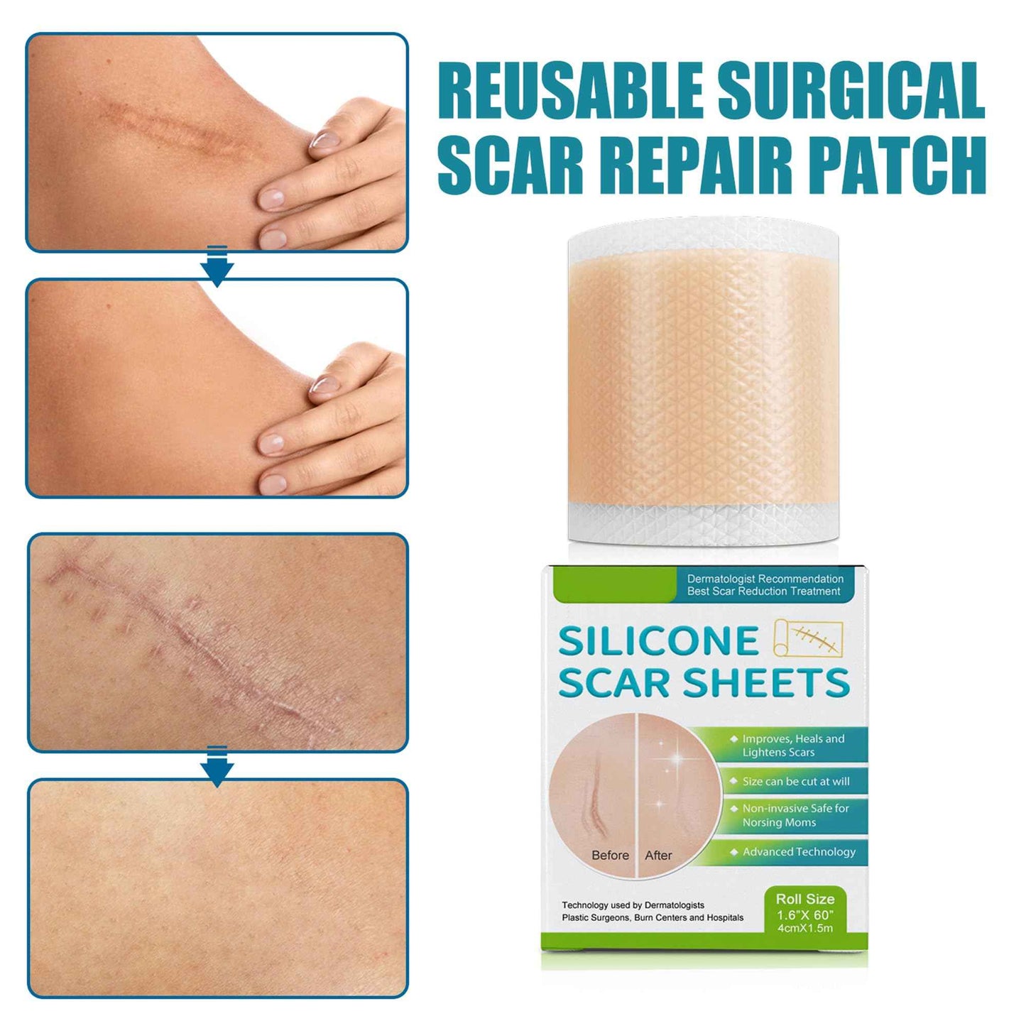 Silicone Scar Sheets - Suitable for Repair of Caesarean Section, Abdominoplasty, Keloid and Surgical Scars(1.6”x 60”)