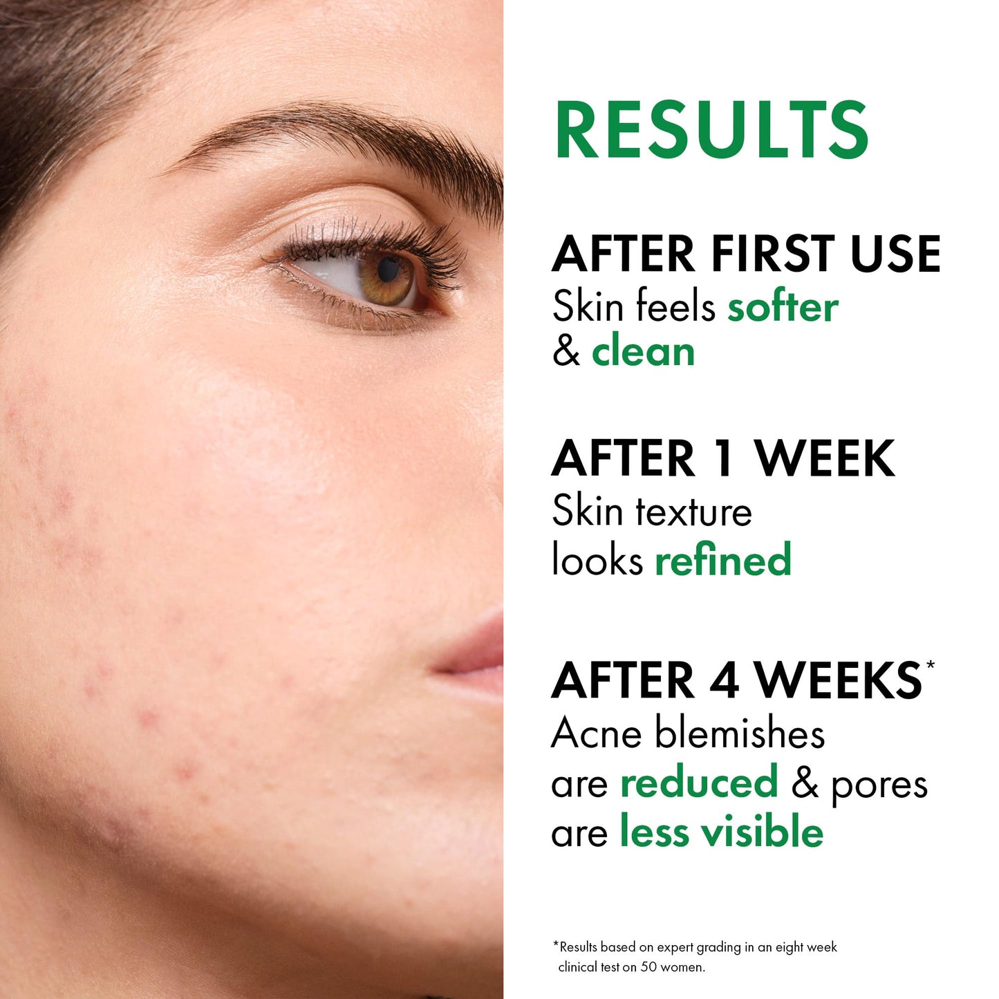 VICHY Normaderm Acne Control Daily Moisturizer,Oil Free Acne Moisturizer For Face,Max Strength 2% Salicylic Acid + Hyaluronic Acid +Vitamin C,Targets Blackheads, Blemishes & Enlarged Pores(Pack of 2)
