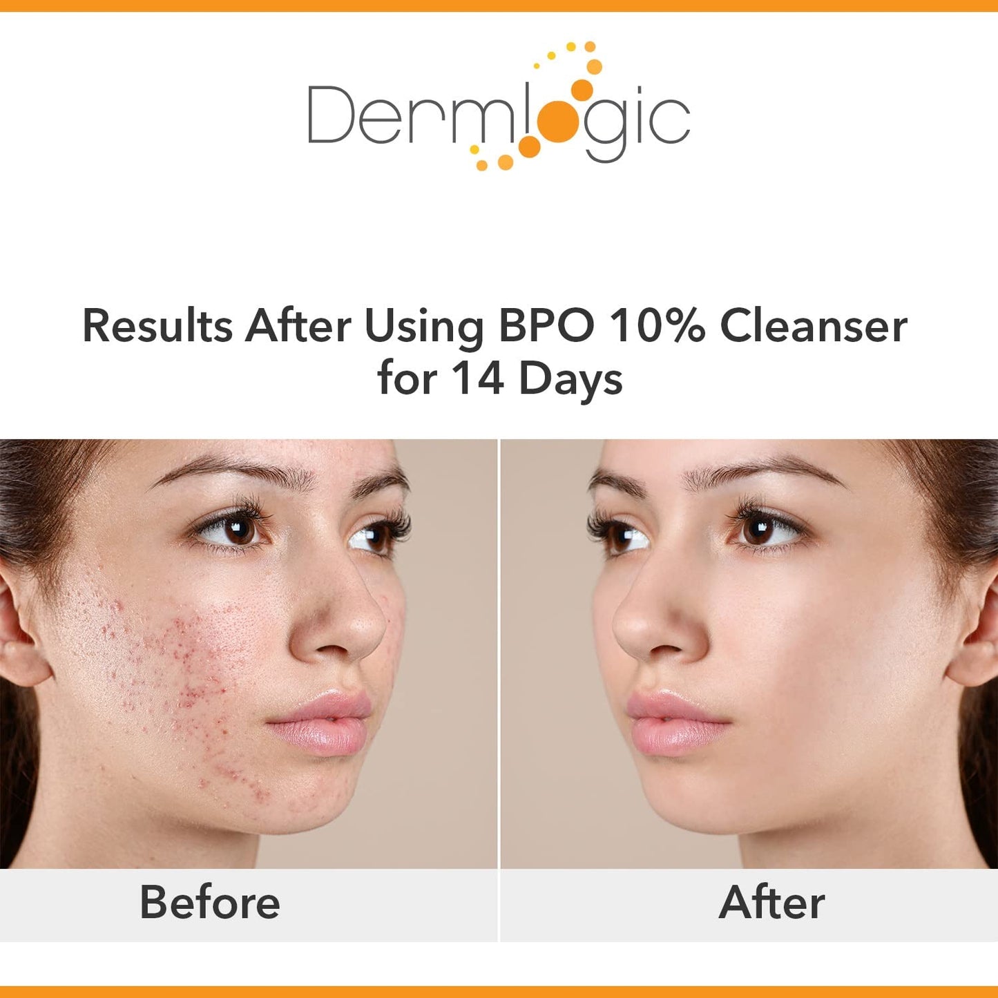 Dermlogic Acne Treatment- 5% Benzoyl Peroxide Face & Body Wash- Penetrates Deep within Pores to Immediately Fight Zits to Clear Skin. Eliminates and Prevents New Pimples from Forming.