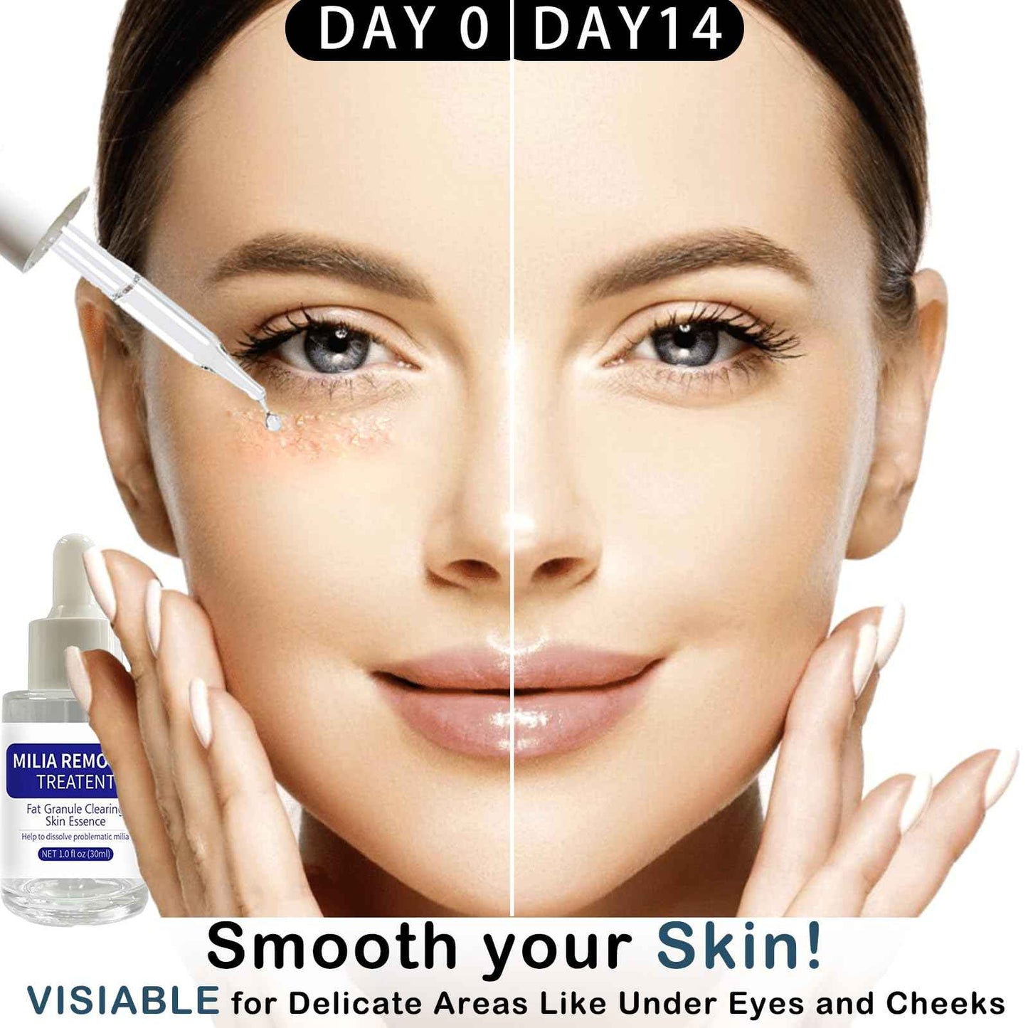 Dermfree Milia Remover Treatment, Milia Spot Treatment with Salicylic Acid Milia Acne Serum Clearing Skin Essence(30ML)