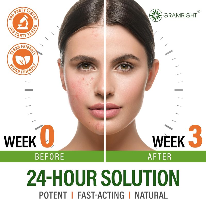 Acne Face Cream - Natural Tea Tree Oil & Salicylic Acid Treatment for All Skin Types | 4 fl. oz Cystic Acne Solution