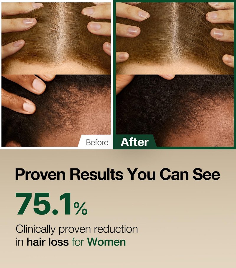 ROOTON Alpha Erguen Hair Loss Treatment for Women, Vegan Conditioner for Thinning Hair, Weak Hair & Scalp Care, Pregnancy Safe Formula & Postpartum Hair Care, 500ml / 16.9 fl oz