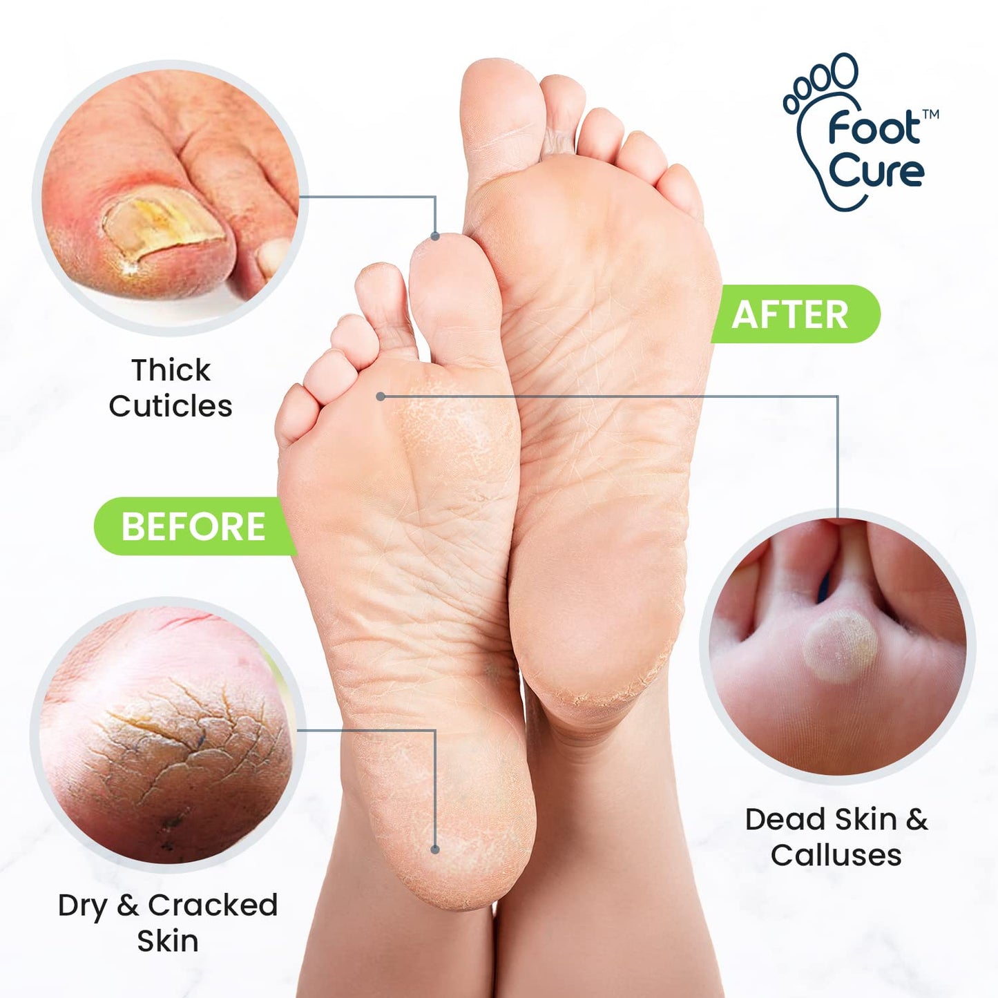 Tea Tree Foot Soak & Callus Remover Gel Kit - Extra Strength Treatment for Cracked Heels & Dry Feet | Epsom Salts Included