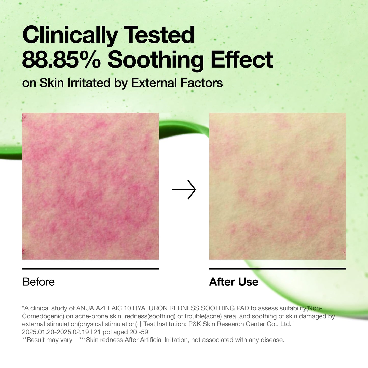 ANUA Azelaic Acid 10 Hyaluronic Acid Soothing Toner Pads, Hydrating Facial Mask for Redness, Pore & Blemish Care, Quick & Easy Stretchable Formula, Korean Skincare, 90 Pads