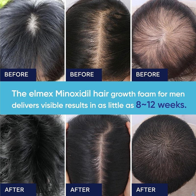 Minoxidil Foam for Hair Growth - 5% Formula for Men & Women | 2 Ounce