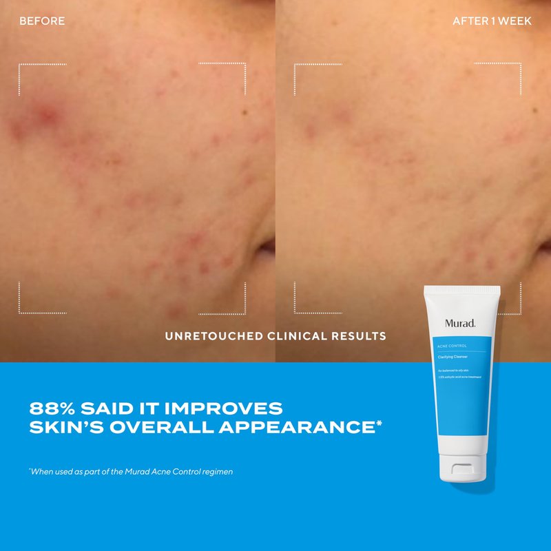 Acne Treatment Trial Kit – Salicylic Acid & Mandelic Acid for Clear Skin – Oil Control, Spot Treatment & Cleanser – Travel Size Skincare for Acne-Prone Skin (3-Piece Clear Skin Kit)