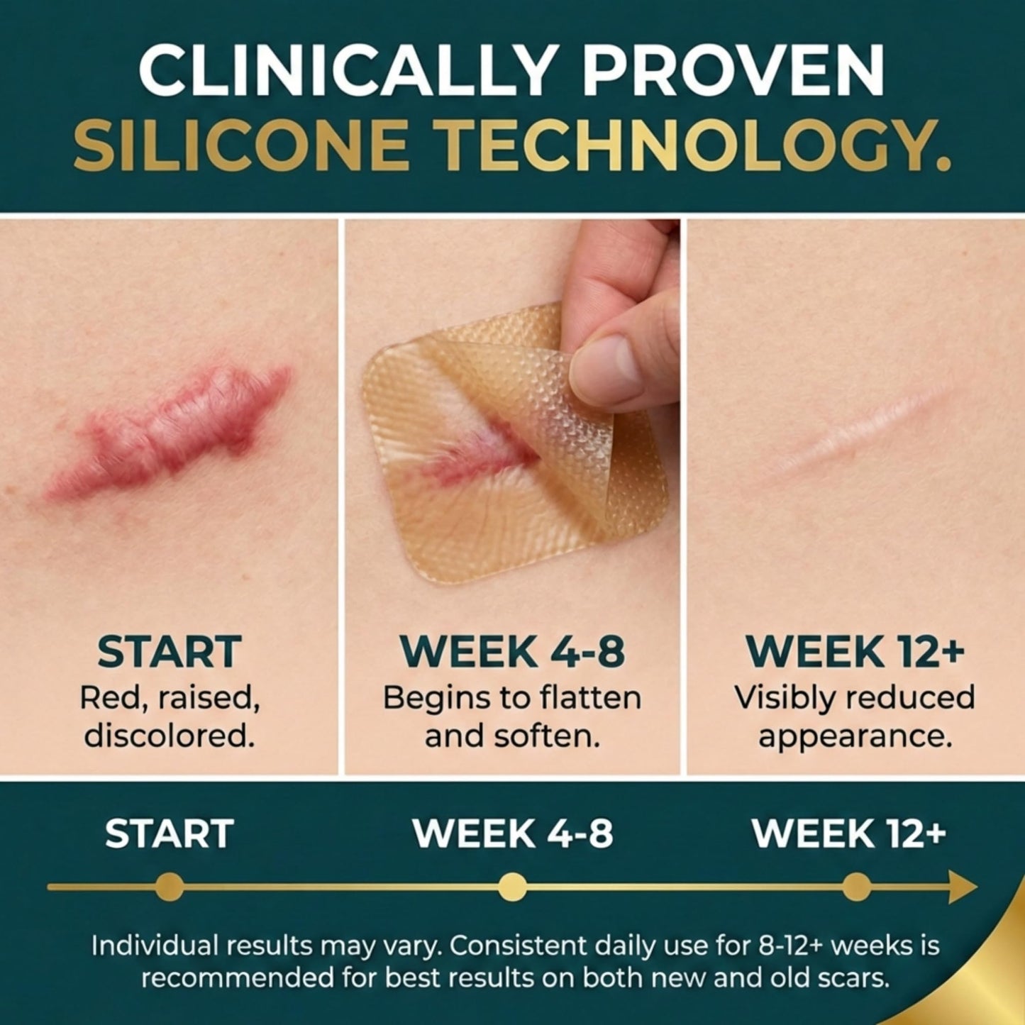 Silicone Scar Sheets, Silicone Scar Tape For Surgical Scars - Clinically Validated Technology Scar Treatment Strips For Hypertrophic, C-Section, Tummy Tuck, Keloid Scars - Reusable, Waterproof
