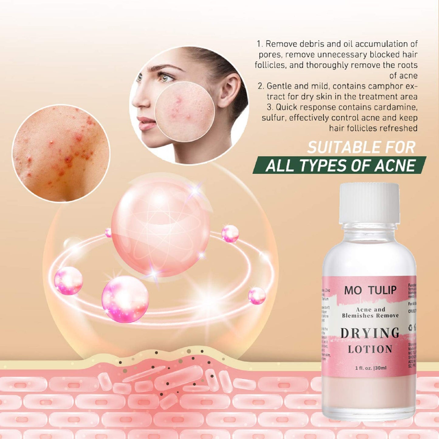 MO TULIP Acne Drying Lotion, Overnight Acne Acid and Acne Spot Treatment for Face and Body, Pimple Lotion Spot Treatment, Dry Out Pimples, Blemishes, and Clean pores (1OZ)