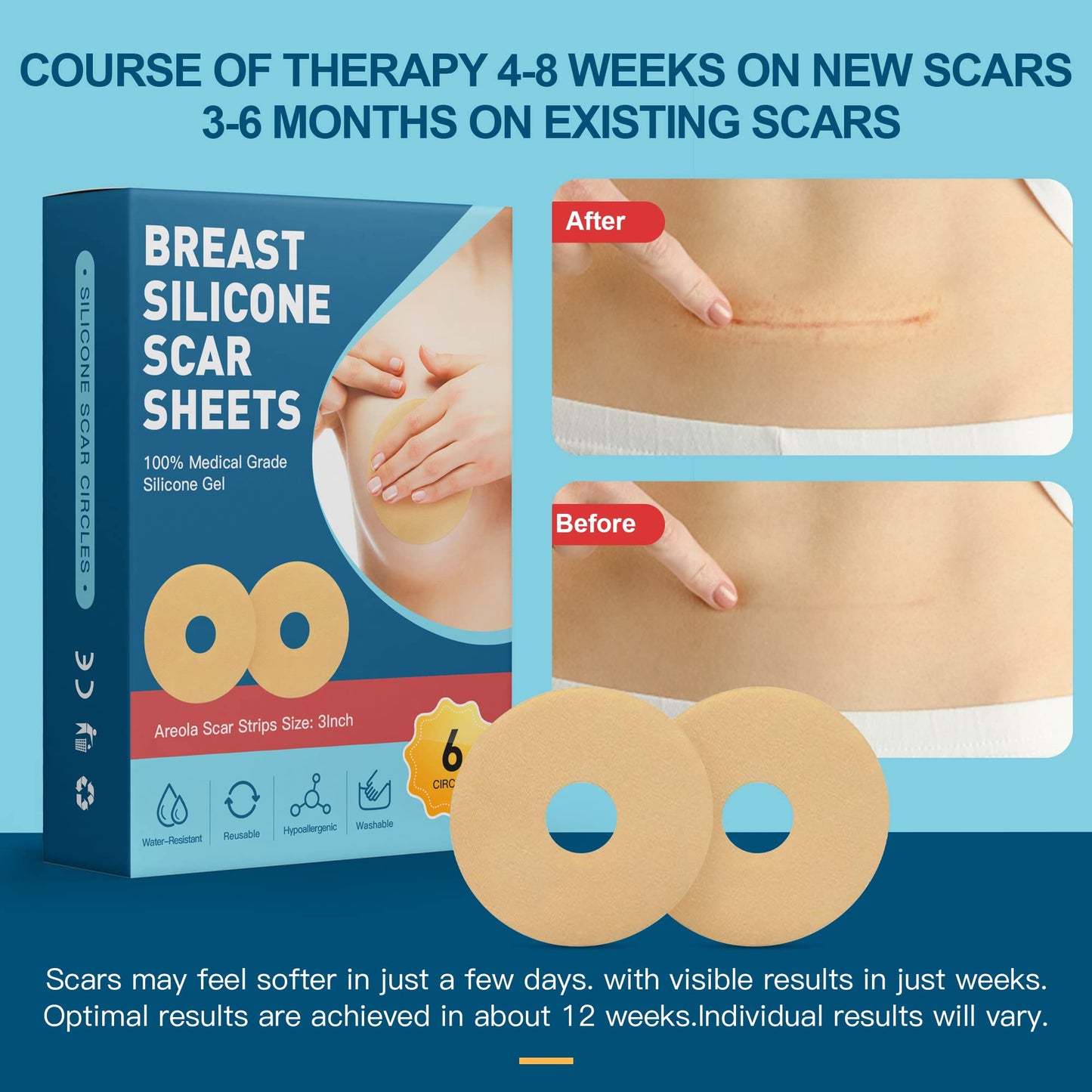 6 Pack Silicone Scar Removal Sheets for Breast - Breast Silicone Scar Sheets Tape - Breast Reduction After Surgery for Scars, Breast Augmentation Post Surgery Supplies for Scar Treatment (blue)