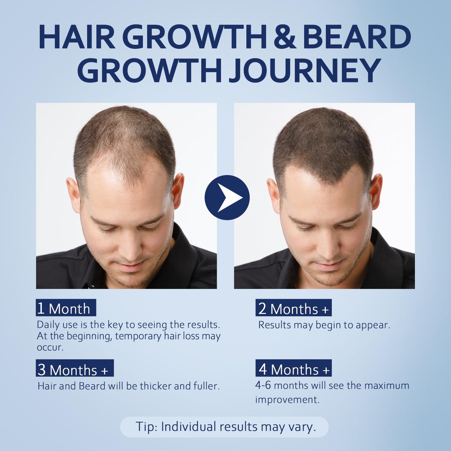 5% Minoxidil Hair Growth Serum for Men & Women with Biotin: Minoxidil for Men and Women, 5 Percent, Hair Regrowth Treatment, Extra Strength (4 FL OZ, Dropper 2pcs)