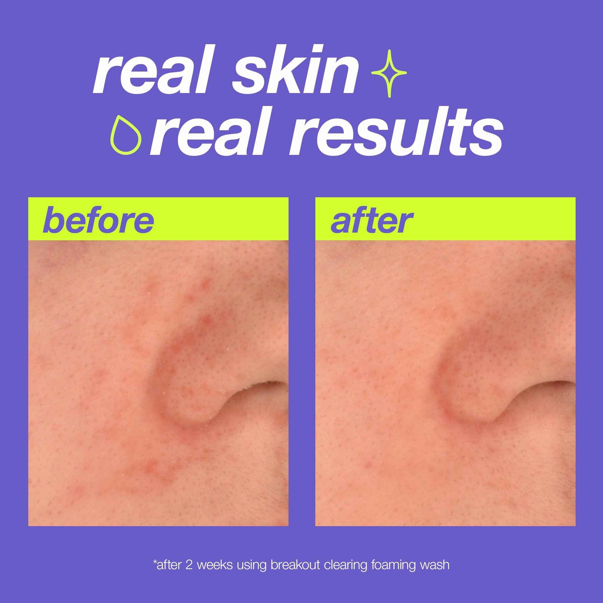 Dermalogica Clear Start Breakout Clearing Foaming Wash - Acne Face Cleanser with Salicylic Acid & Tea Tree Oil - 6 fl oz