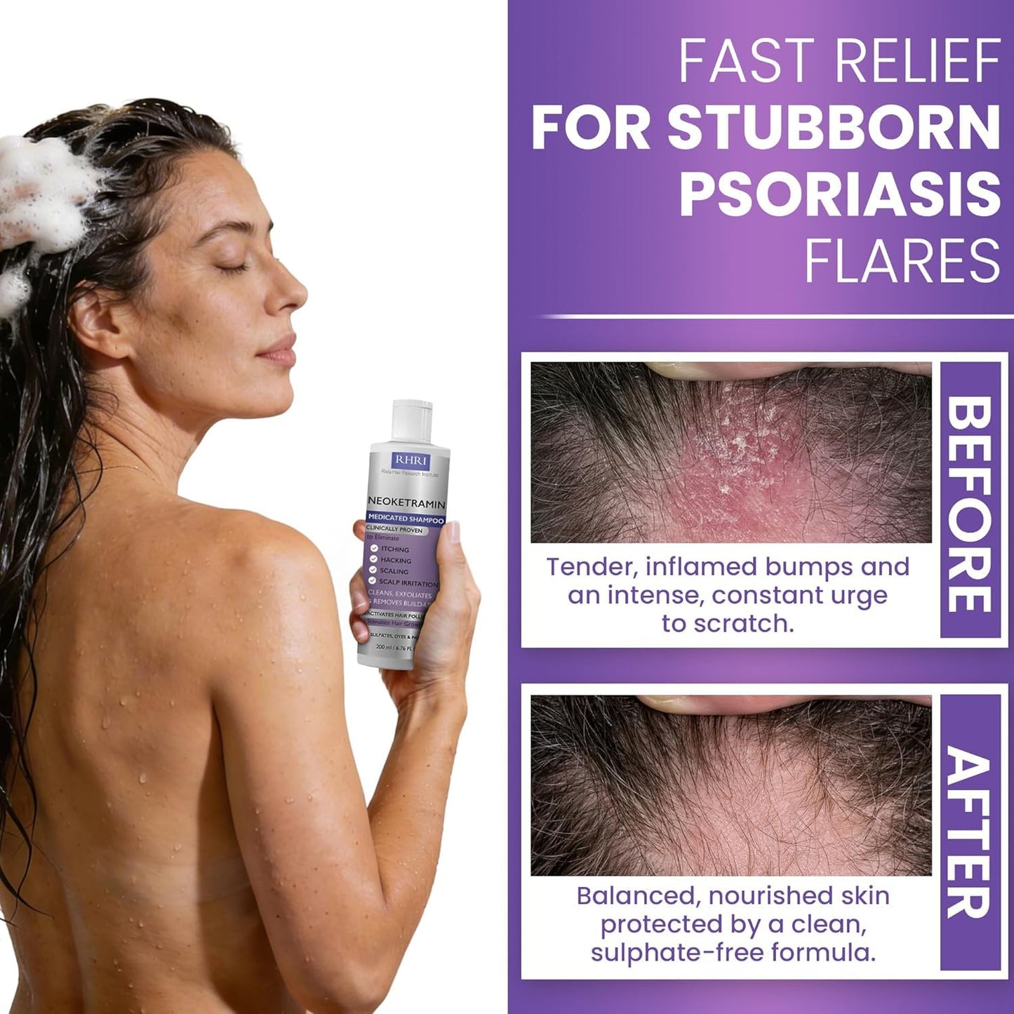 Anti Fungal Shampoo for Men & Women | Anti Dandruff, Medicated, Folliculitis Shampoo for Dry Scalp, Psoriasis, Ringworm | for Itchy, Flaky & Irritated Scalp | No Paraben & Sulphate | w/Dandruff Brush