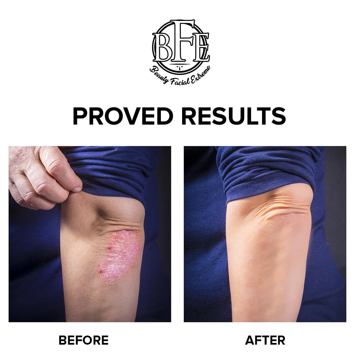 Keratosis Pilaris Exfoliating Body Lotion– 12% Lactic Acid. Provides Immediate Moisture & Gentle Exfoliation to Treat symptoms Associated with Keratosis Pilaris (KP) & Dry, Bumpy Skin Conditions.