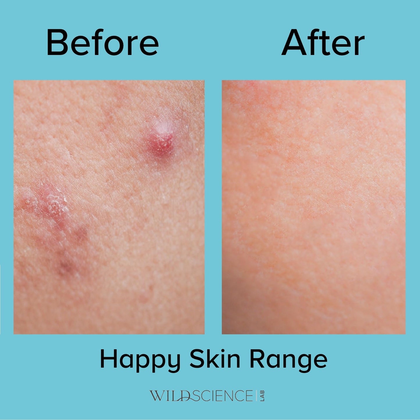 Wild Scicen Lab HAPPY BALANCE AHA + BHA + Zinc Clarifying Essence for Acne-Prone Skin