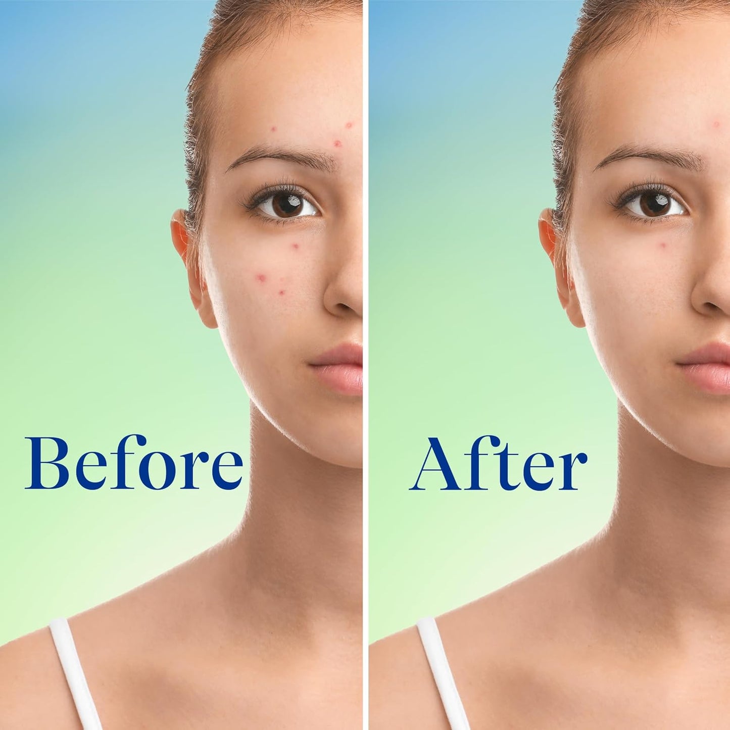 Differin Acne Face Wash - 10% Benzoyl Peroxide Foaming Cleanser | Fast-Acting Acne Treatment, 5 oz.