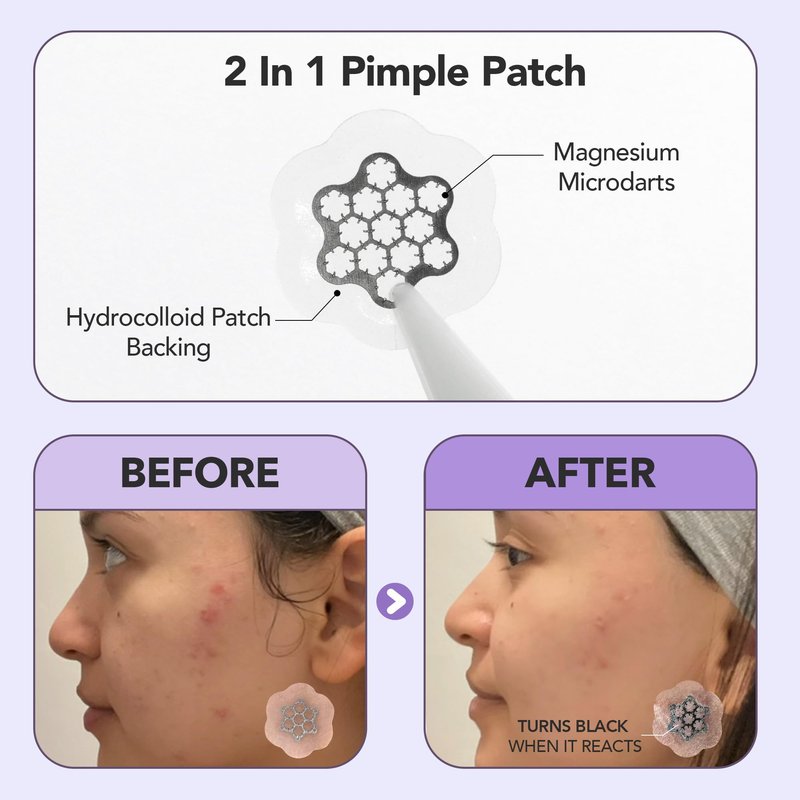 FreeGo Magnesium Blemish Microdarts Pimple Patch | Fast-Acting | Quick Calming | 99.9% Pure Magnesium | Madecassic Acid | Tea Tree | Eucalyptus Leaf | Hydrocolloid Spot Care Patch | 15 Patches