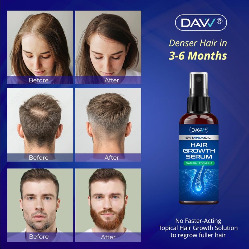 Minoxidil Hair Growth Serum for Men & Women - Extra Strength Biotin & Rosemary Formula | 60ML