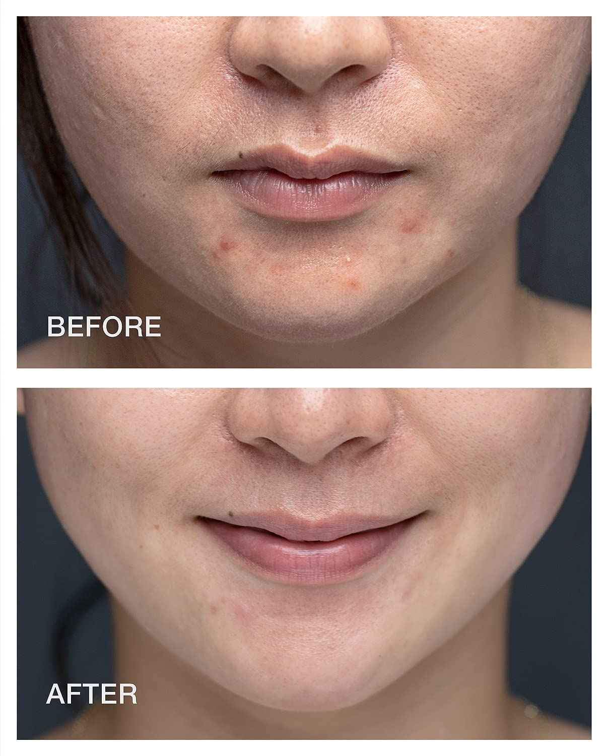 Pestle & Mortar Clarify 2% Salicylic Acid Toner, Acne Treatment and Clear Breakouts, Facial Exfoliant to removes Excess Oil, 2.7 oz