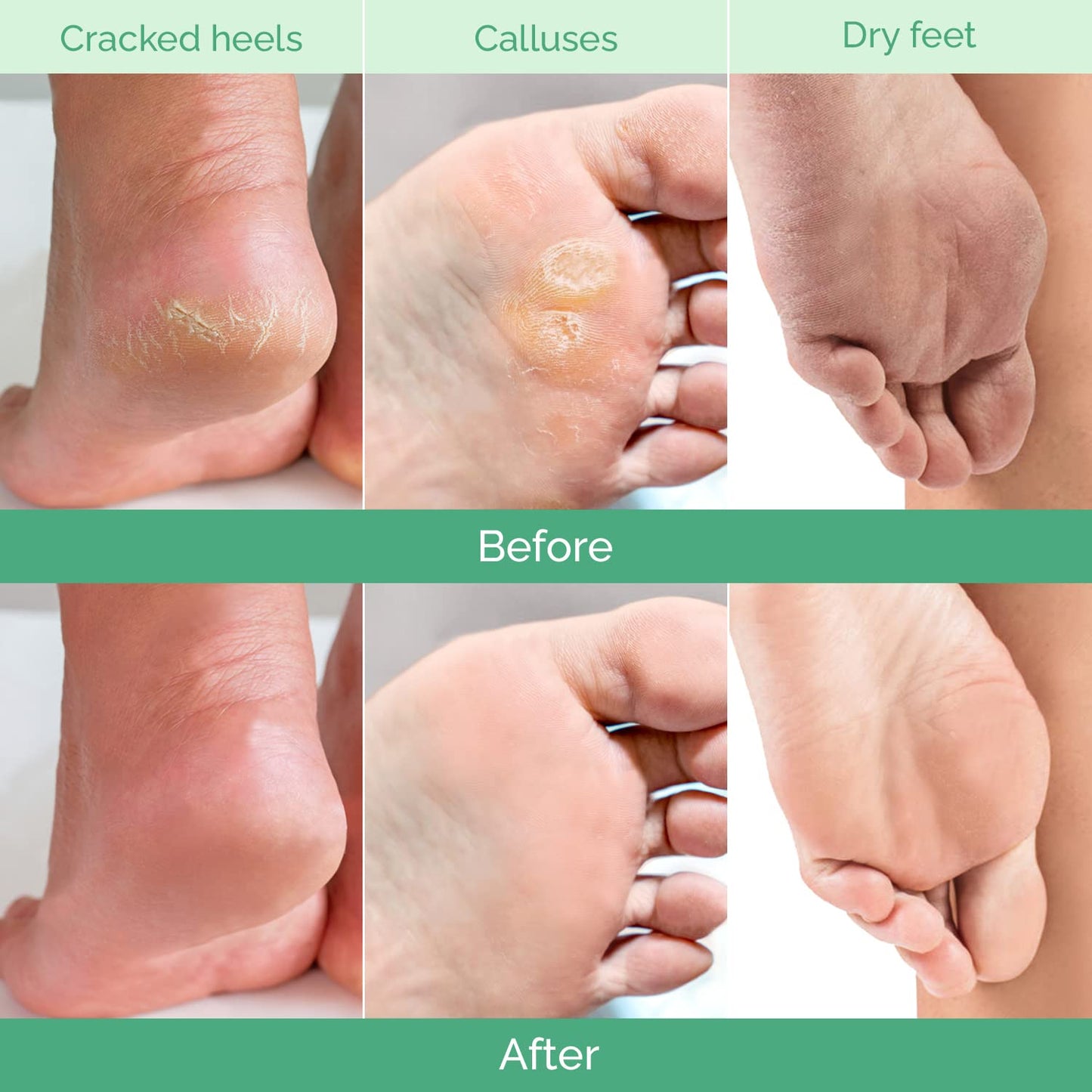 Foot Peeling Mask - Hydrating Treatment for Dry & Cracked Feet | 4 Pack