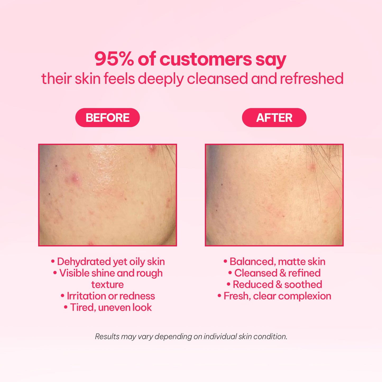 Millford AC Oil-Free Hydrating Jelly 2.7Oz, 80ml, Oil Free Facial Moisturizer for Acne-Prone Skin, Niacinamide 2%, Unscented, Mild, Soothing Cream, Non Greasy Moisturizer, Korean Skincare