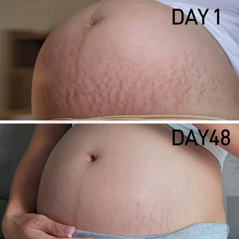 PEGO Stretch Mark Oil for Pregnancy, Maternity Body Oil for Stretch Mark Prevention & Reduction, Hydrating Skin Care, 5.41oz (Oil+Cream)