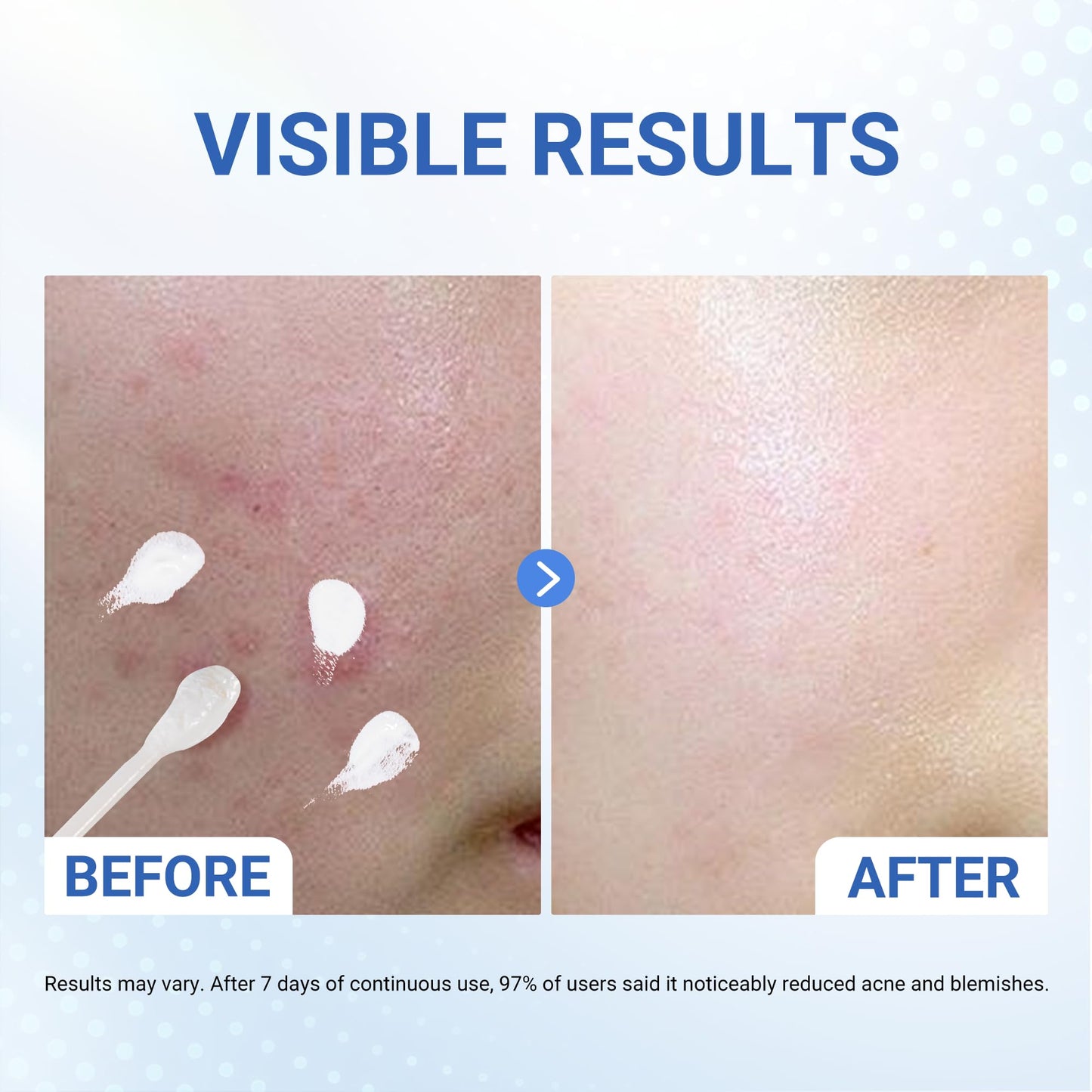 Salicylic Acid Acne Treatment Drying Lotion