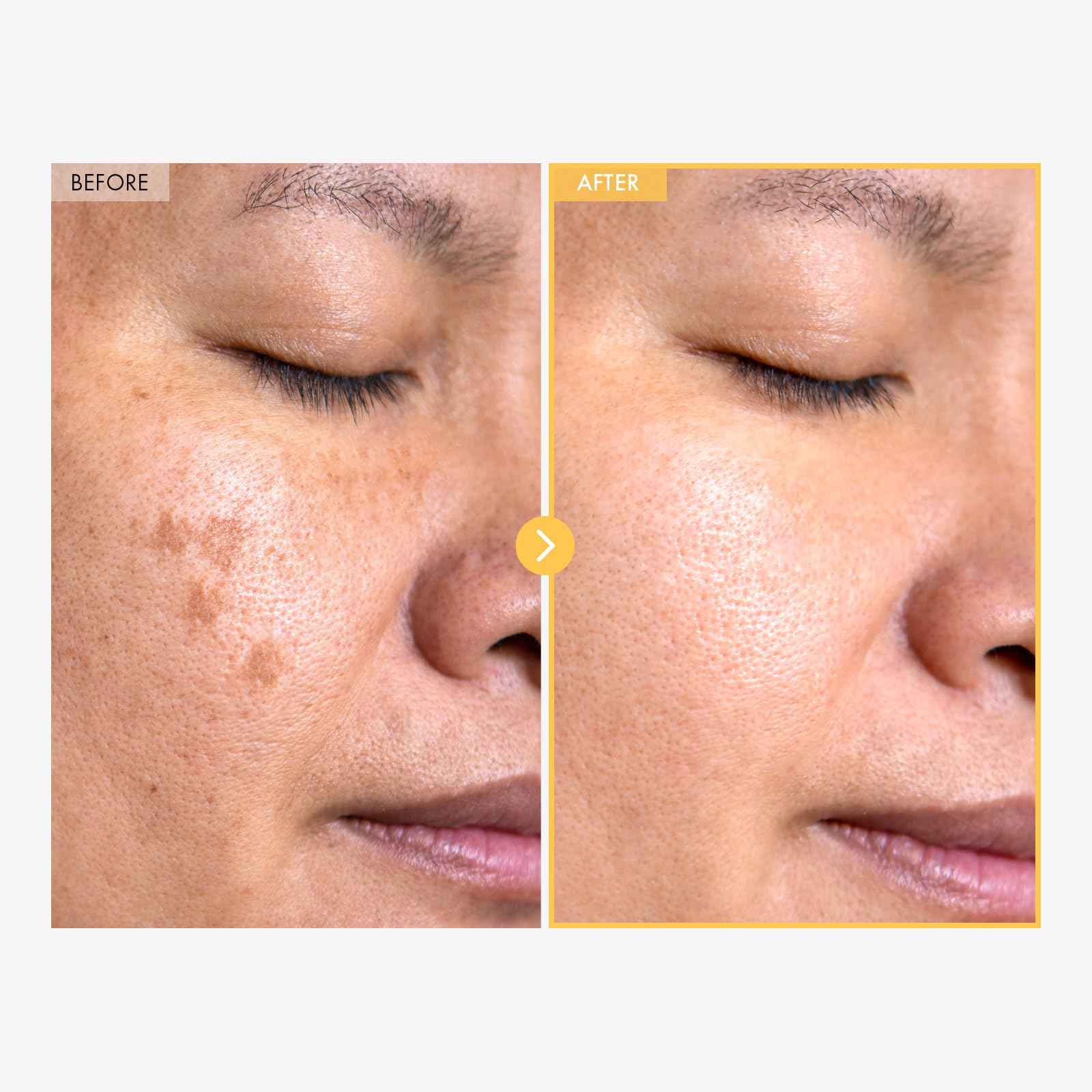 TOSOWOONG Eraser Liquid Patch with Niacinamide, Tranexamic Acid and Centella Asiatica Extract, 15g, 0.52 oz.