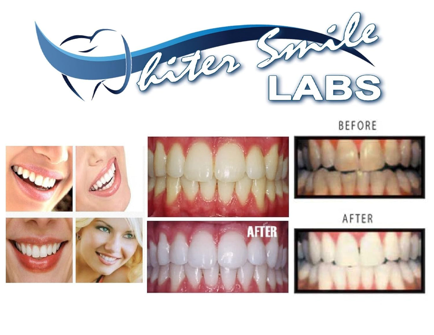 Teeth Whitening Gel - 38% Carbamide Peroxide for Fast Results | Sensitivity-Free, Dentist Recommended, 5 XL