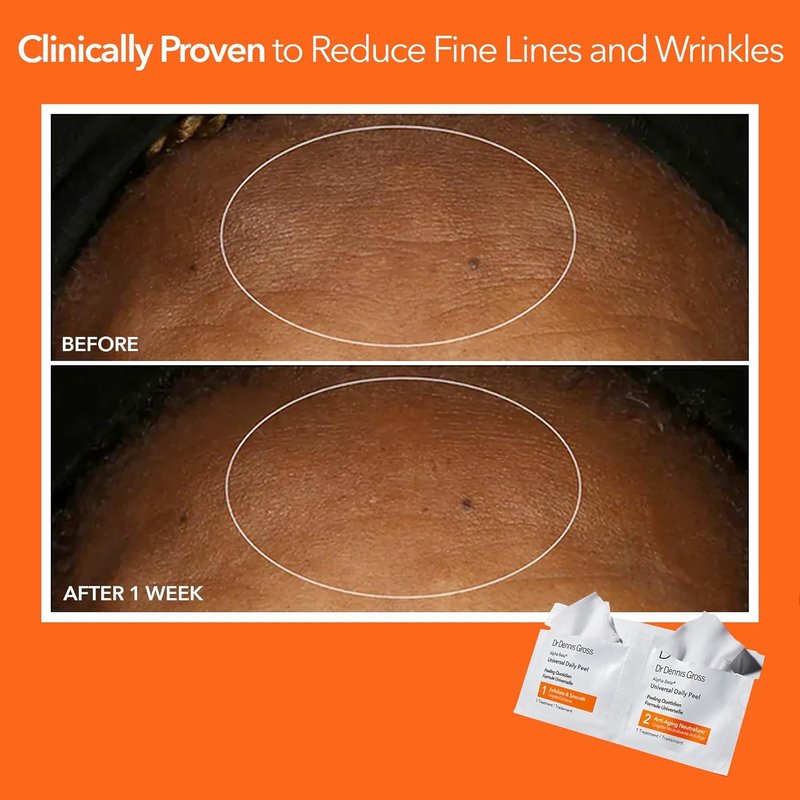 Dr. Dennis Gross Alpha Beta Daily Peel - Universal Treatment for Uneven Skin Tone & Fine Lines | 5 Treatments