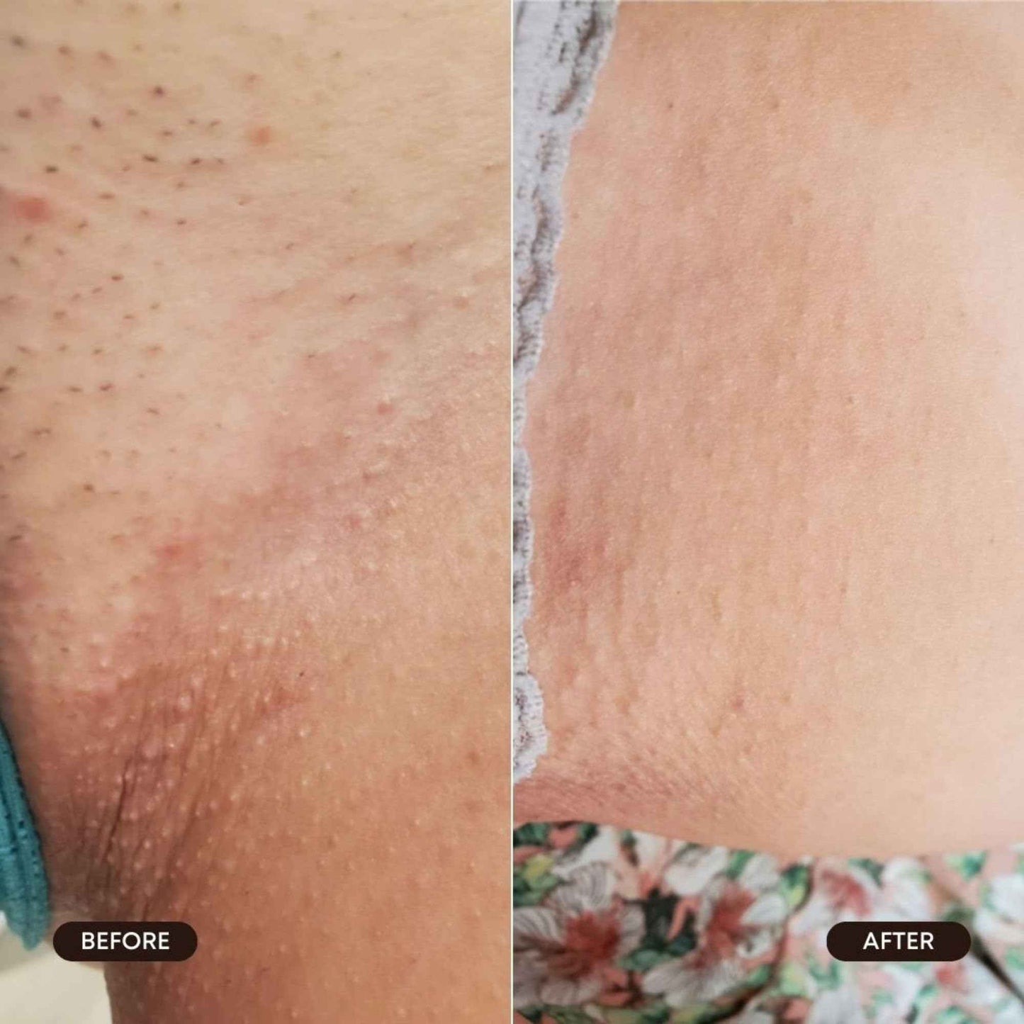 Bushbalm Roller Rescue Ingrown Hair Serum, Includes AHA and BHA - Exfoliating, Soothing, Cooling for Intimate Areas, Underarms - Helps With Razor Bumps and Ingrown Hairs, Blue 50 ml