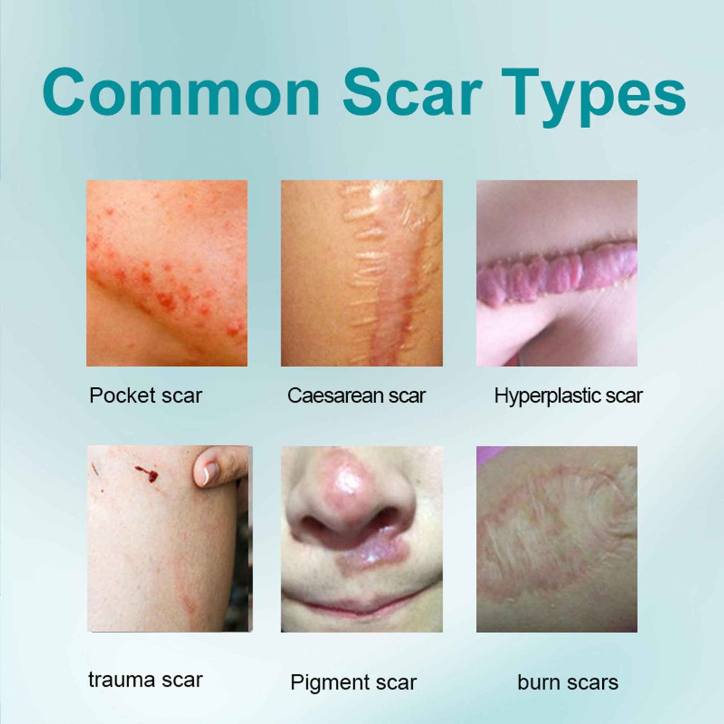 Silicone Scar Gel 20g, Effective Scar Cream - Reduces The Appearance of Both Old and New Scars from Burns, Injury, Acne, Stretch Marks, Keloid, C-Section