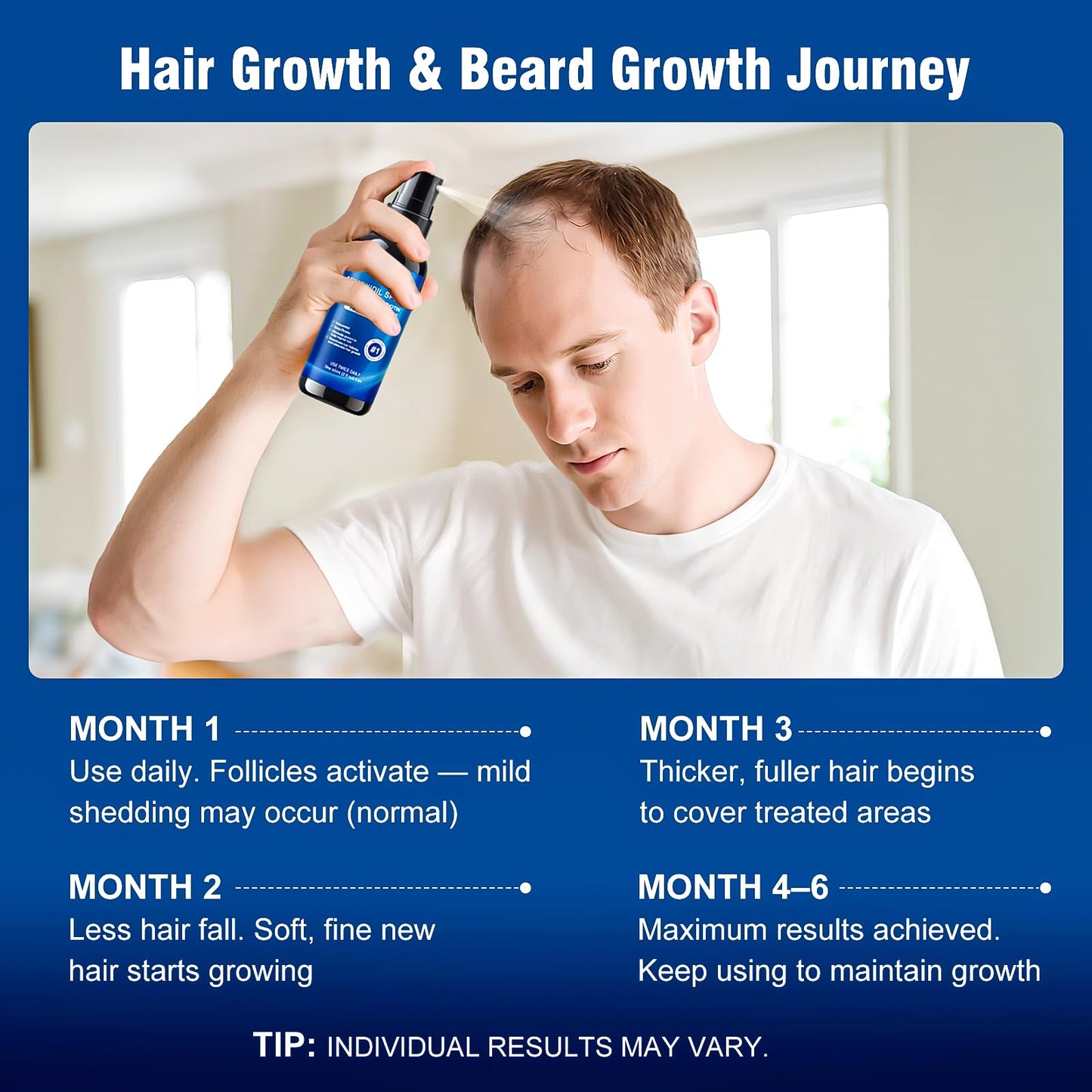 5% Minoxidil Spray for Men and Women,Infused with Biotin, Hair Growth Treatment,Topical hair growth serum,Supports Thicker and Fuller Hair & Beard (6 Pcs,12 Fl Oz Total,6 Month Supply)