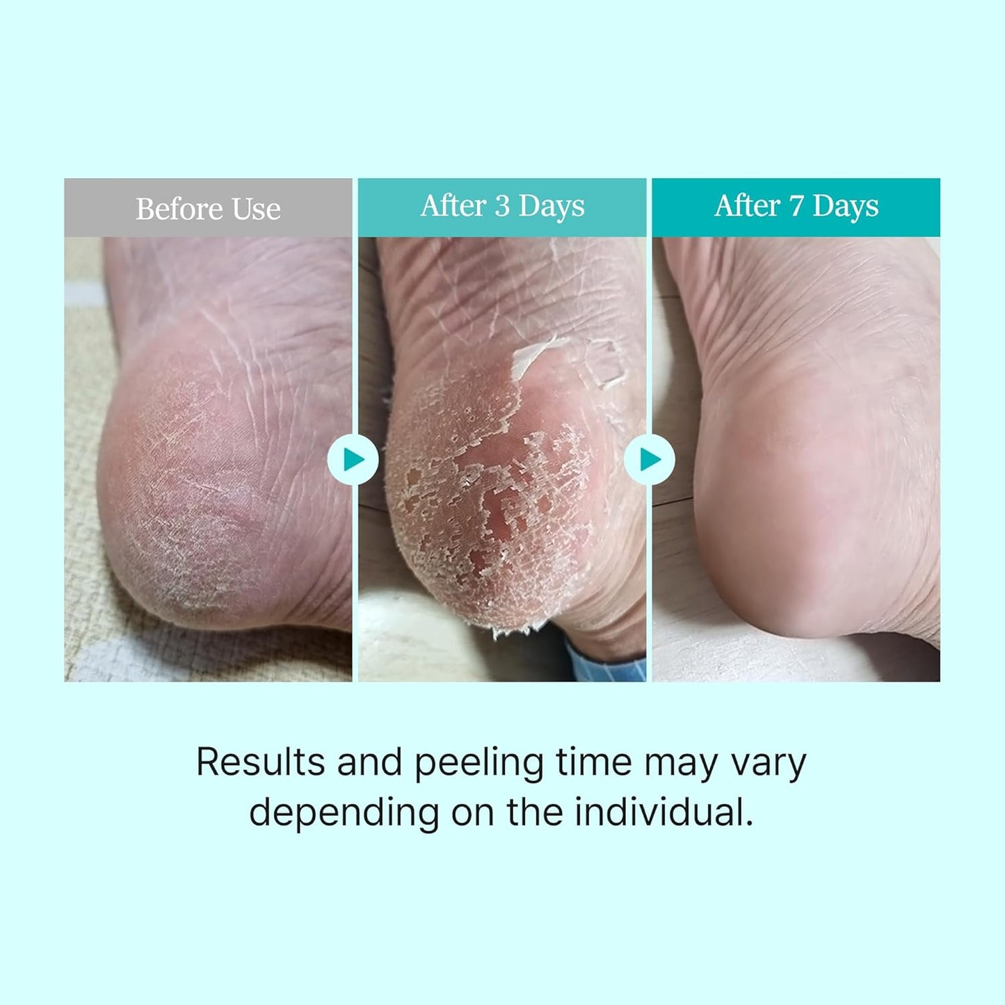 Ariul Foot Peel Mask | Calming Exfoliating Socks for Sensitive Skin - 2 Pairs (Tea Tree)