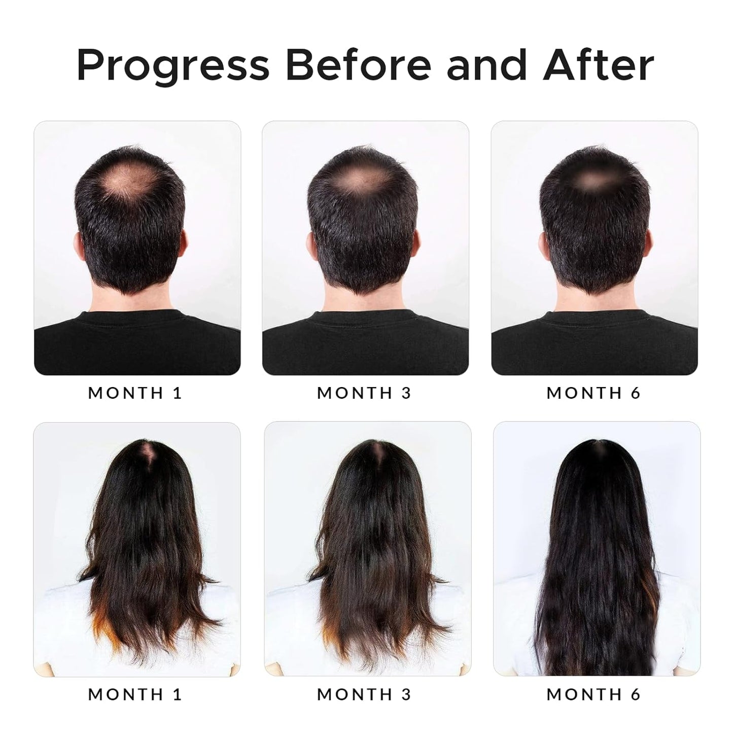 Minoxidil & Biotin Shampoo for Hair Growth - Caffeine, Castor Oil & Onion Infused | DHT Blocker for Thicker, Healthier Hair