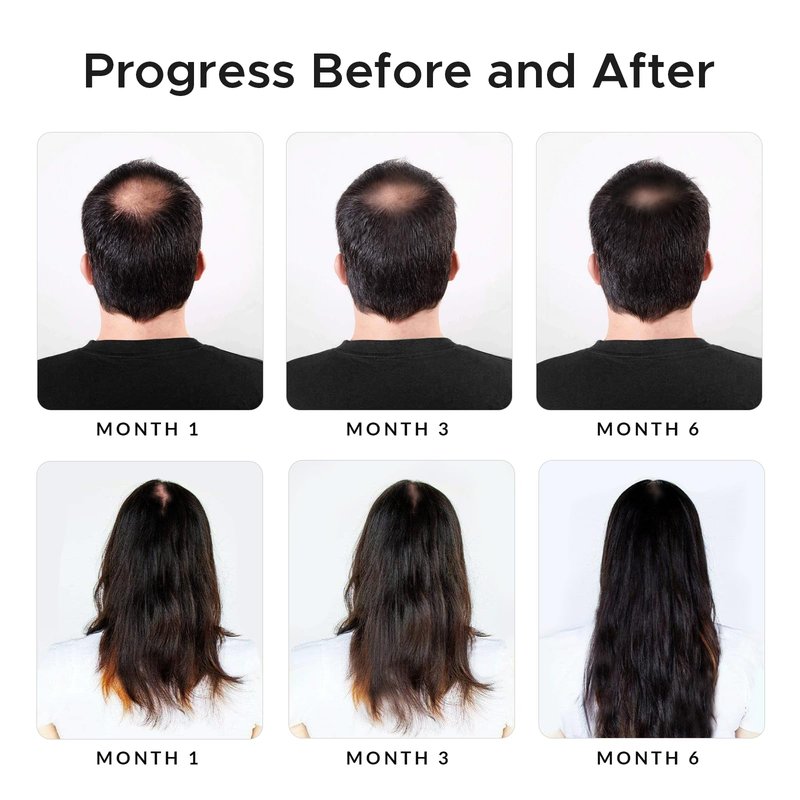 Minoxidil & Biotin Shampoo for Hair Growth - Enriched with Caffeine, Castor Oil & Onion - DHT Blocker for Thicker, Healthier Hair - Strengthening Formula for Men & Women
