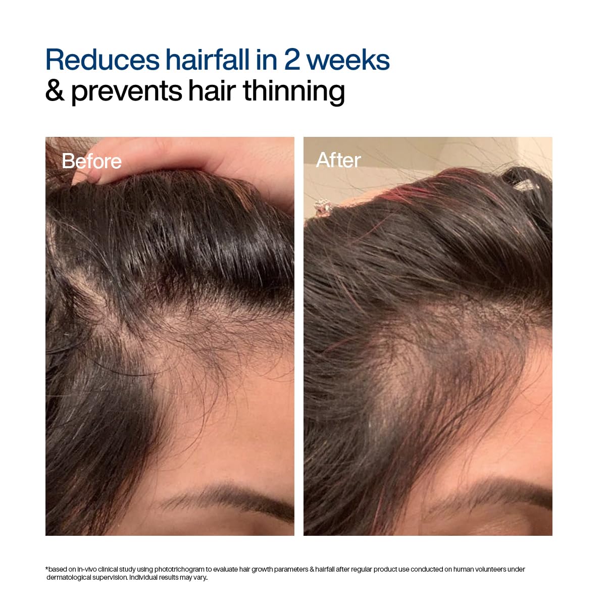 WishCare Hair Growth Serum Concentrate - Rosemary, 3% Redensyl, 4% Anagain, 2% Baicapil, Caffeine, Biotin, Plant Keratin & Rice Water