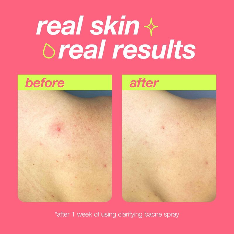 Dermalogica Clear Start Clarifying Bacne Spray, Back Acne Treatment Spray for Body Breakout - Pore Clearing, Preventing Pimple with Salicylic Acid, Witch Hazel, Tea Tree Oil, All Skin Type, 6 fl oz
