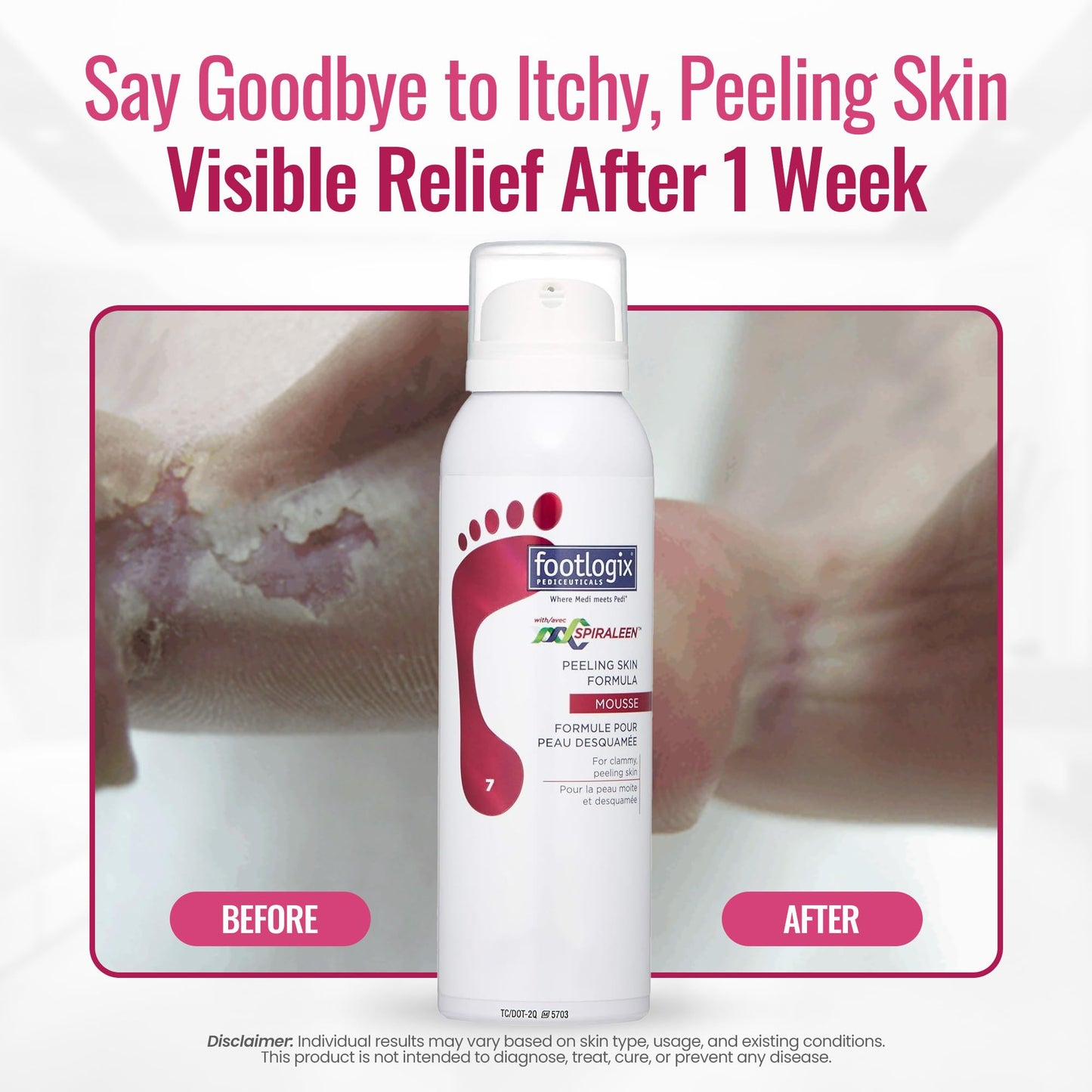 FOOTLOGIX Peeling Skin Formula with Spiraleen® 4.23 oz | Foot Care Mousse with Tea Tree Oil, Aloe Vera & Vitamin E | Lightweight Moisturizer for Dry Skin Between Toes | Pediceutical Formula