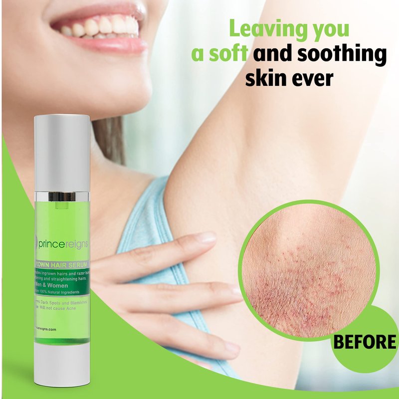 Princereigns Ingrown Hair Serum - Organic Razor Bump & Redness Solution for Men & Women, Ideal for Face, Bikini, Legs, Underarm, Prevents Future Ingrown Hairs, No Alcohol or Oils - 2 Fl. Oz