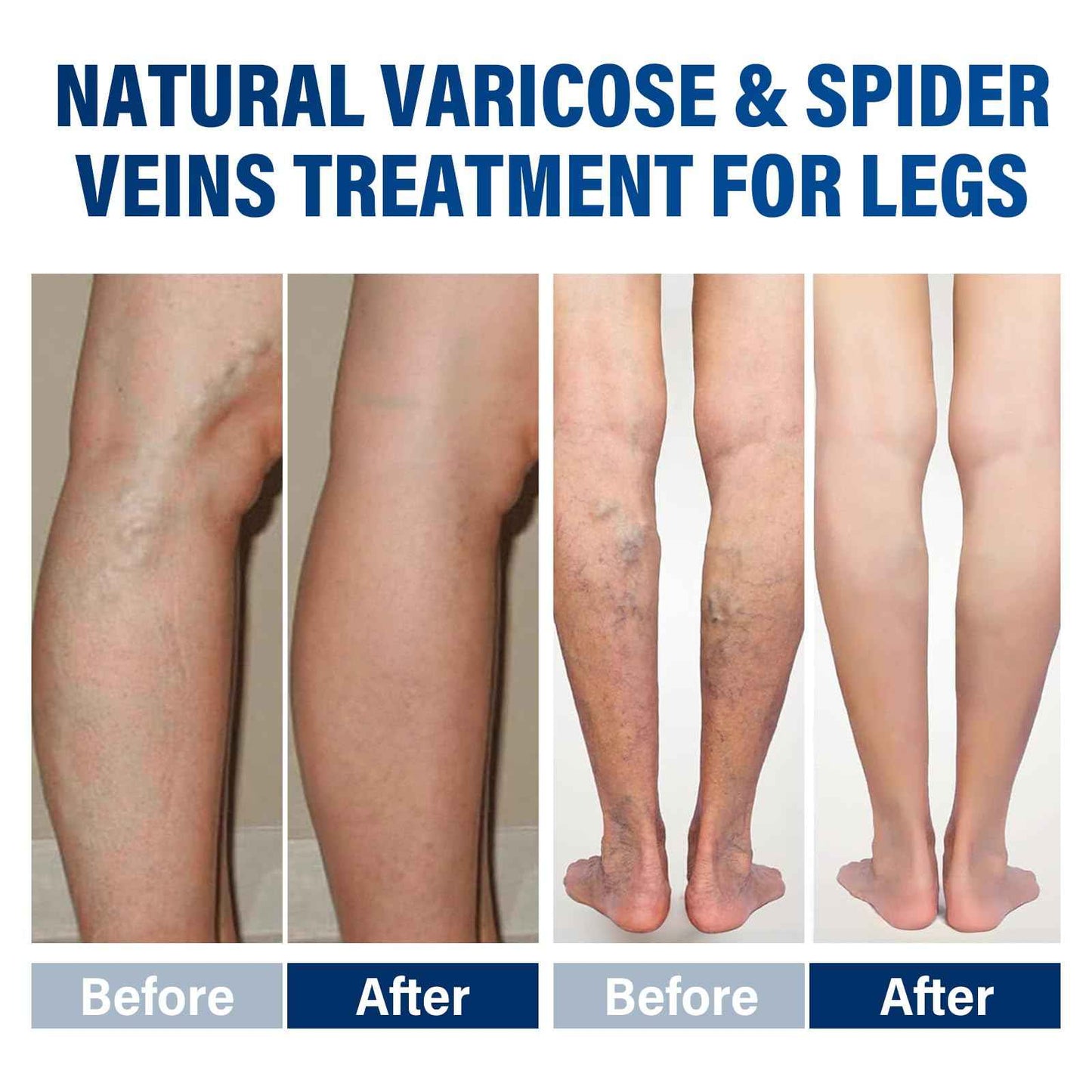 Josera Varicose Veins Treatment for Legs, 2 Count Varicose Veins Cream - Improves Blood Circulation and Reduces Heaviness