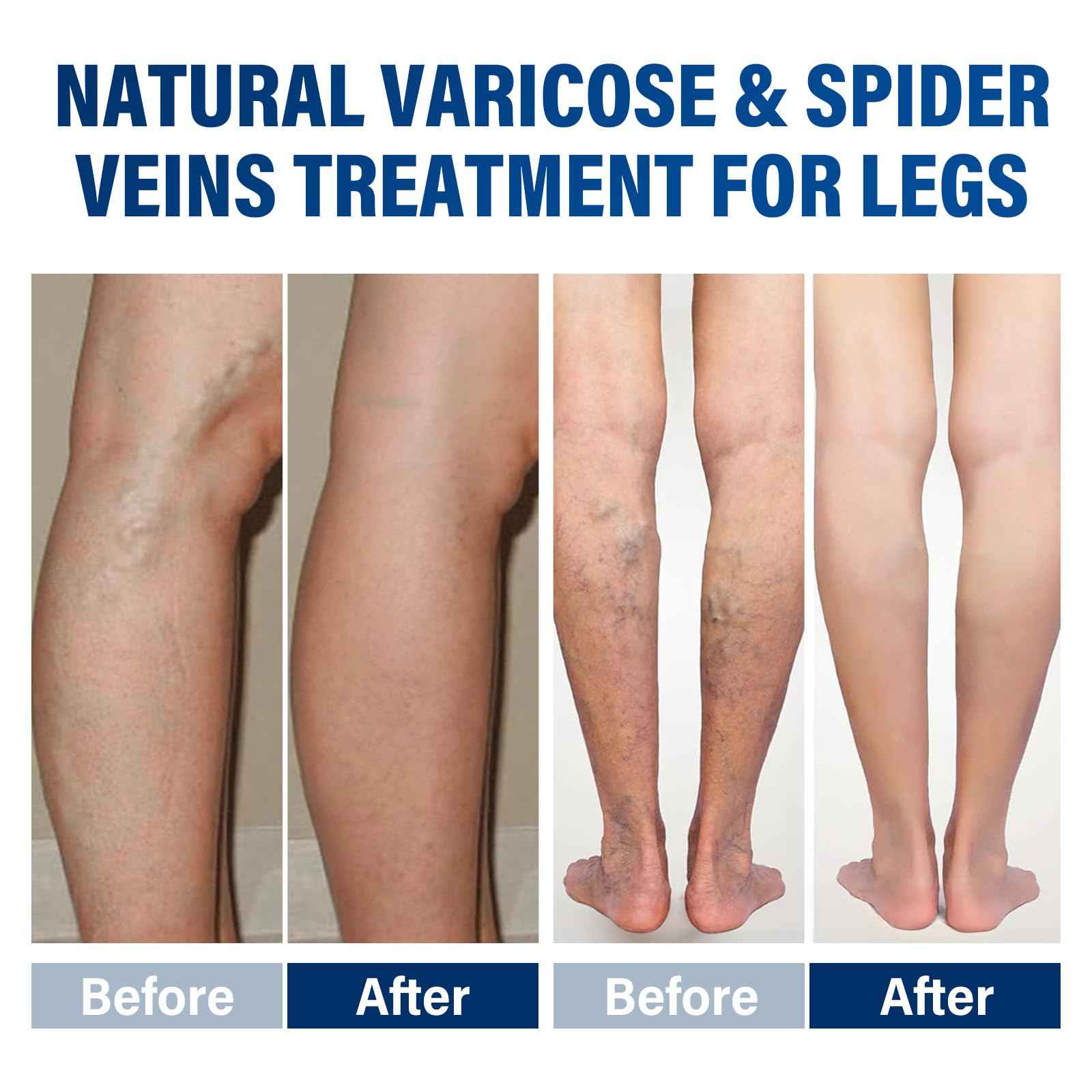Josera Varicose Veins Treatment for Legs, 2 Count Varicose Veins Cream - Improves Blood Circulation and Reduces Heaviness