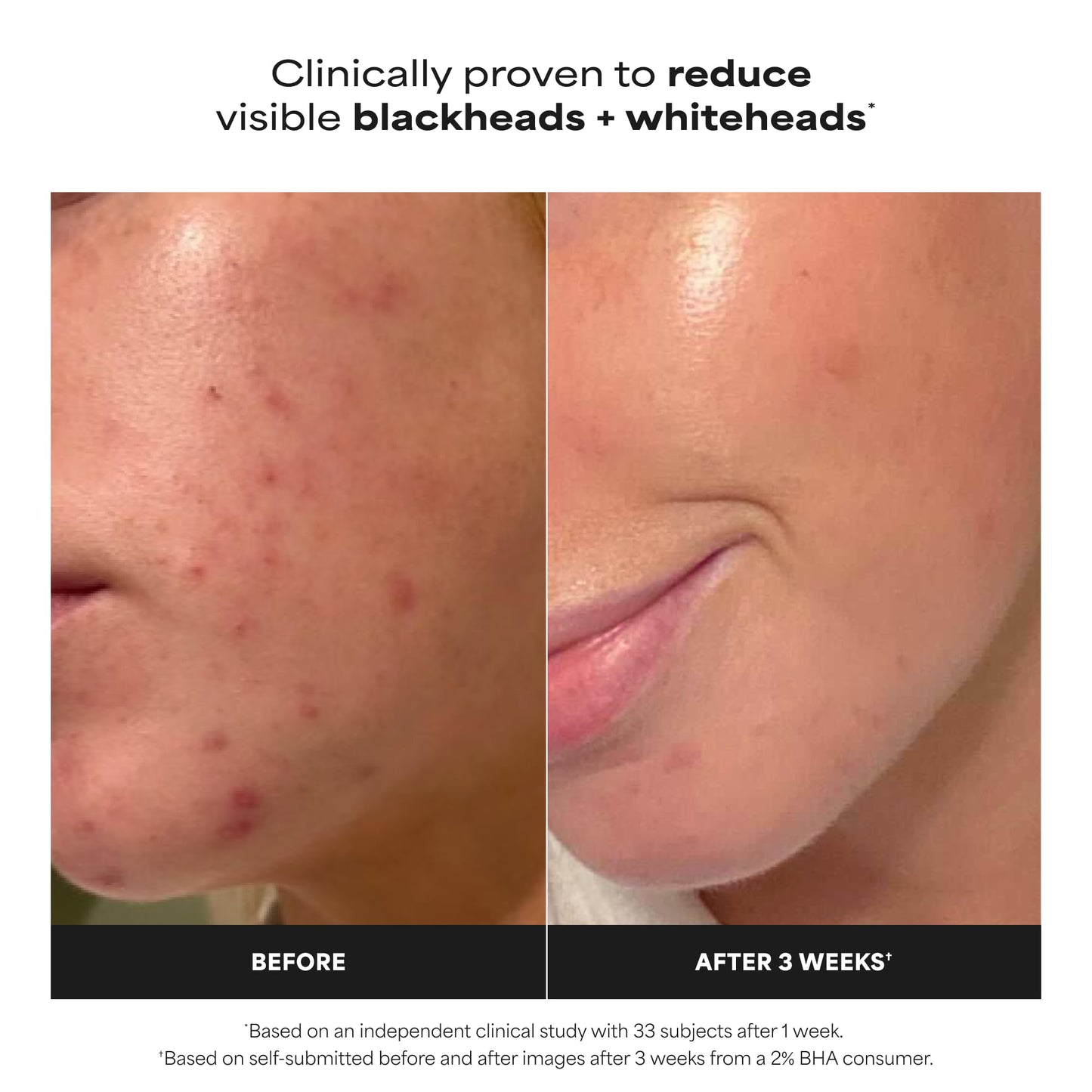 Paula's Choice SKIN PERFECTING 2% BHA Liquid Exfoliant with Salicylic Acid, Facial Polish for Pores, Wrinkles & Fine Lines, Suitable for Blackhead-Prone Skin, Fragrance-Free (5 Fl Oz (Pack of 2))