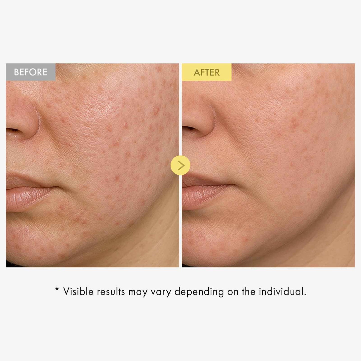 TOSOWOONG Honey Glow 65% Propolis Serum, Hyaluronic Acid, Kojic Acid, Niacinamide, Hydrating Facial Soothing Moisturizer for Irritated Uneven Skin Tone, Glass Skin, Korean Skin Care, 33ml, 1.11 fl.oz.