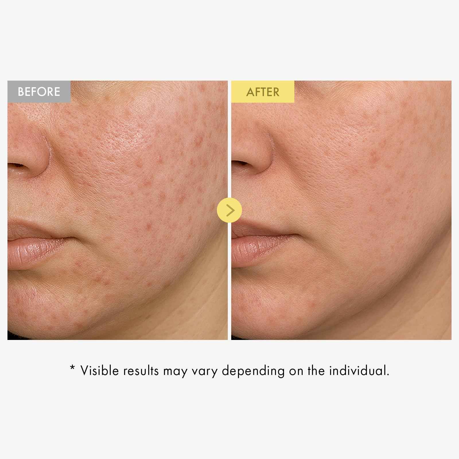 TOSOWOONG Honey Glow 65% Propolis Serum, Hyaluronic Acid, Kojic Acid, Niacinamide, Hydrating Facial Soothing Moisturizer for Irritated Uneven Skin Tone, Glass Skin, Korean Skin Care, 33ml, 1.11 fl.oz.