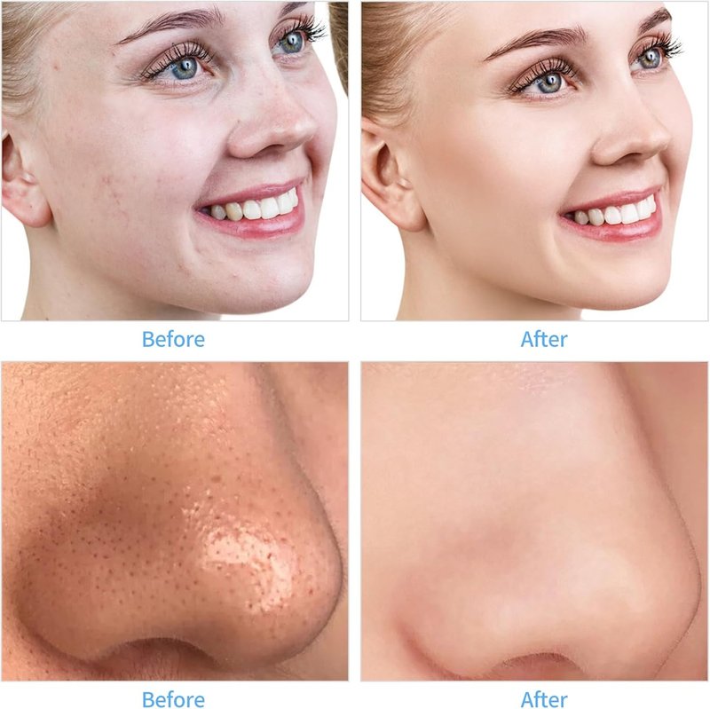 Microdermabrasion Machine - Portable Facial Skin Care Tool | Blackhead Remover Kit for Home Use