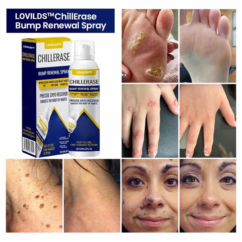 LOVILDS ChillErase Bump Renewal Spray, Professional Salicylic Acid Spray for Skin, Reduces Skin Imperfections for All Parts of the Body (2PCS)