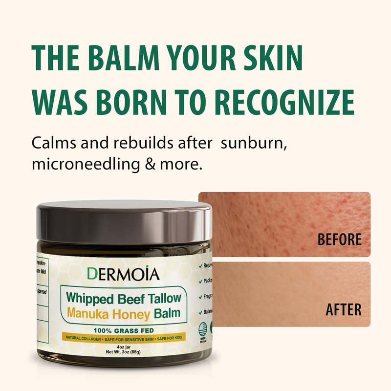 DERMOIA Grass Fed Whipped Beef Tallow for Skin with Manuka Honey - Silky Smooth, Fast Absorbing Tallow & Honey Balm - Ideal for Kids & Eczema Prone Area - Whipped Moisturizer for Dry & Sensitive Skin