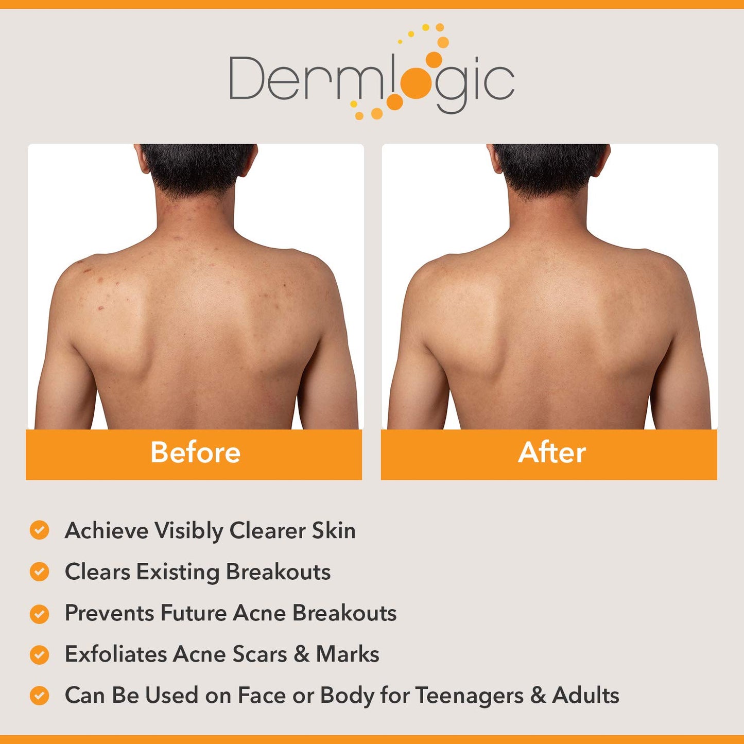 Dermlogic Acne Treatment- 5% Benzoyl Peroxide Face & Body Wash- Penetrates Deep within Pores to Immediately Fight Zits to Clear Skin. Eliminates and Prevents New Pimples from Forming.